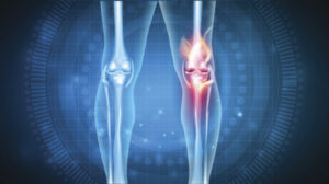 Read more about the article If you have knee pain, telehealth may help